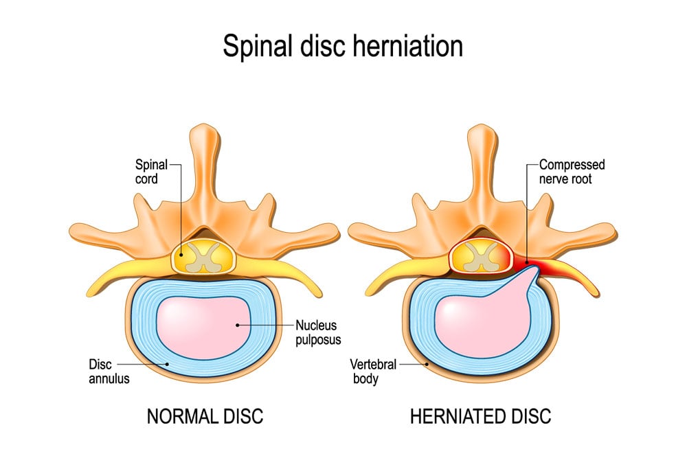 Lumbar Transforaminal Epidural Steroid Excel Pain and Spine