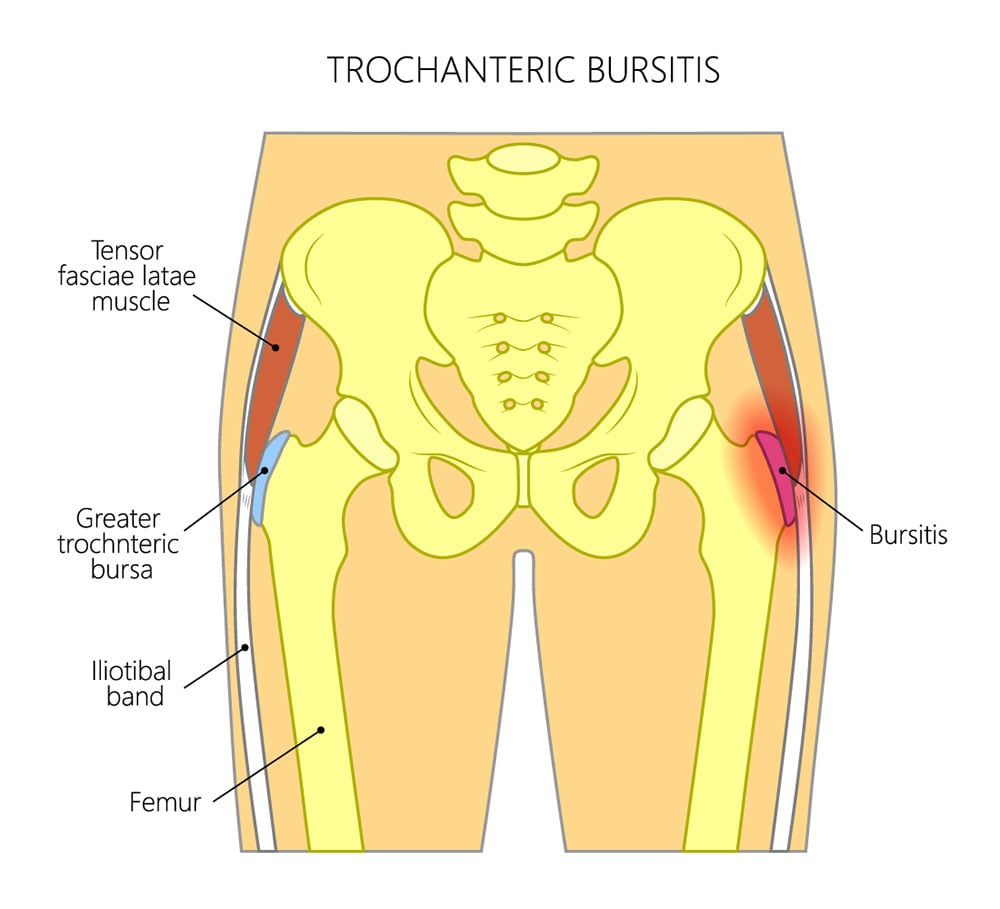 bursa-injections