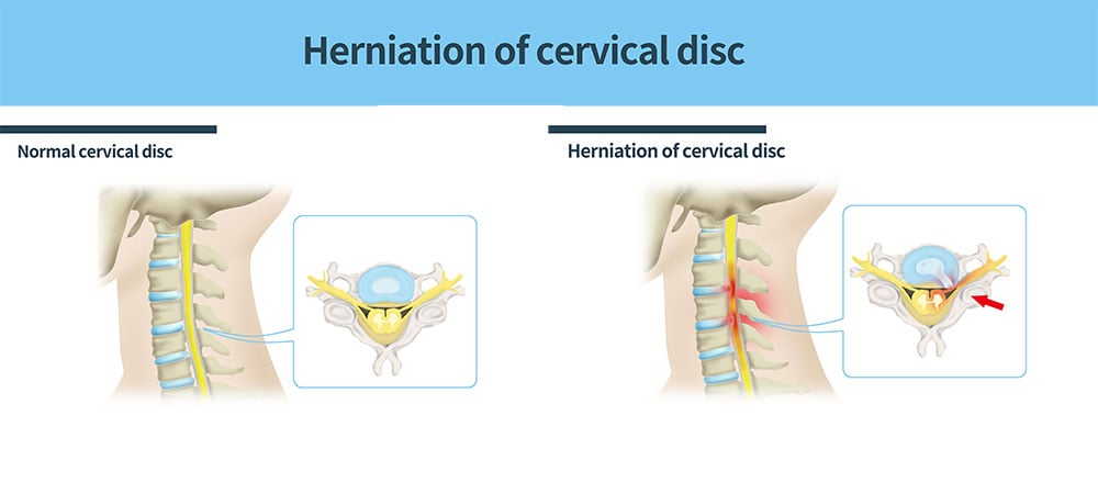 cervical-epidural-steroid-injection