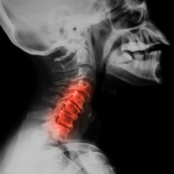 biografi snyde nåde Cervical Medial Branch Block and Radiofrequency Ablation (RFA) | Excel Pain  and Spine