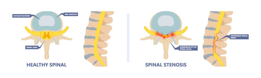 direct-and-indirect-spinal-decompression