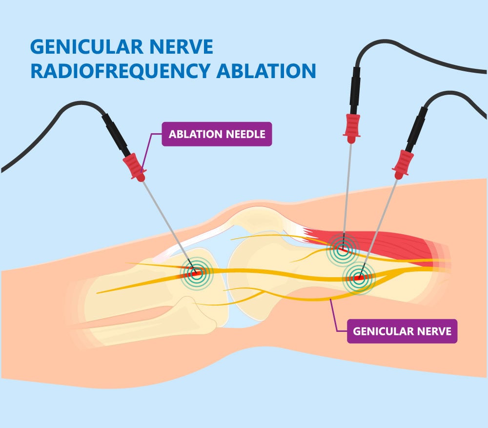 Genicular Nerve Block and Radiofrequency Ablation (RFA) Excel Pain