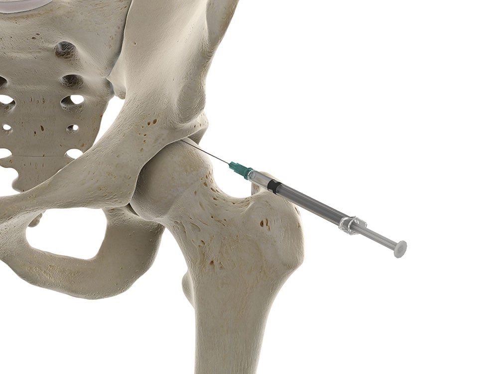 IntraArticular Hip Injection Excel Pain and Spine