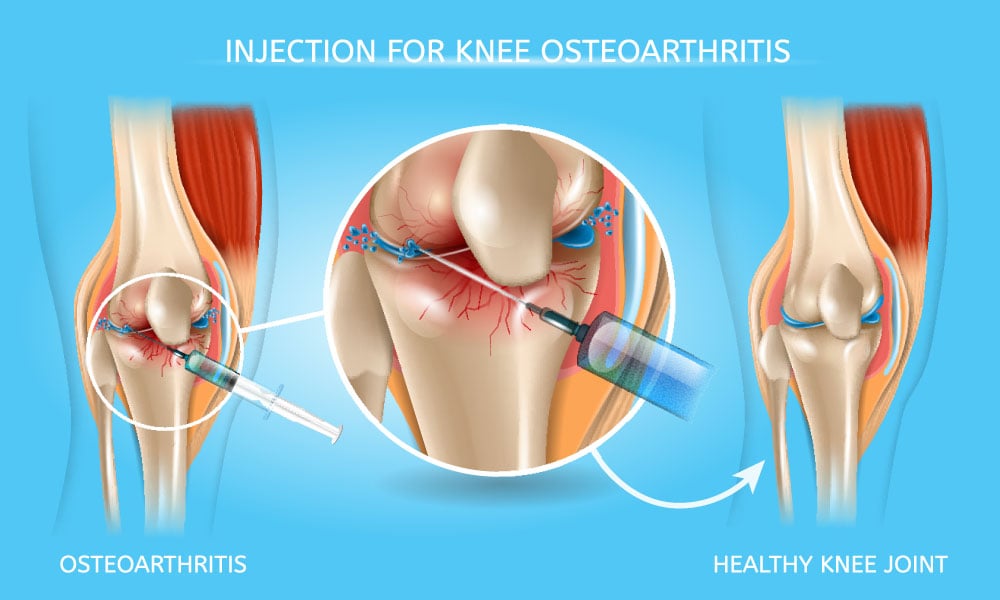 intra-articular-knee-injection