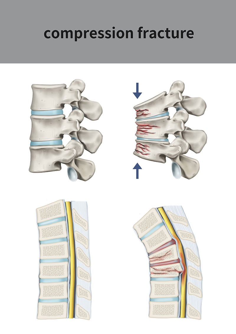 kyphoplasty-and-sacroplasty