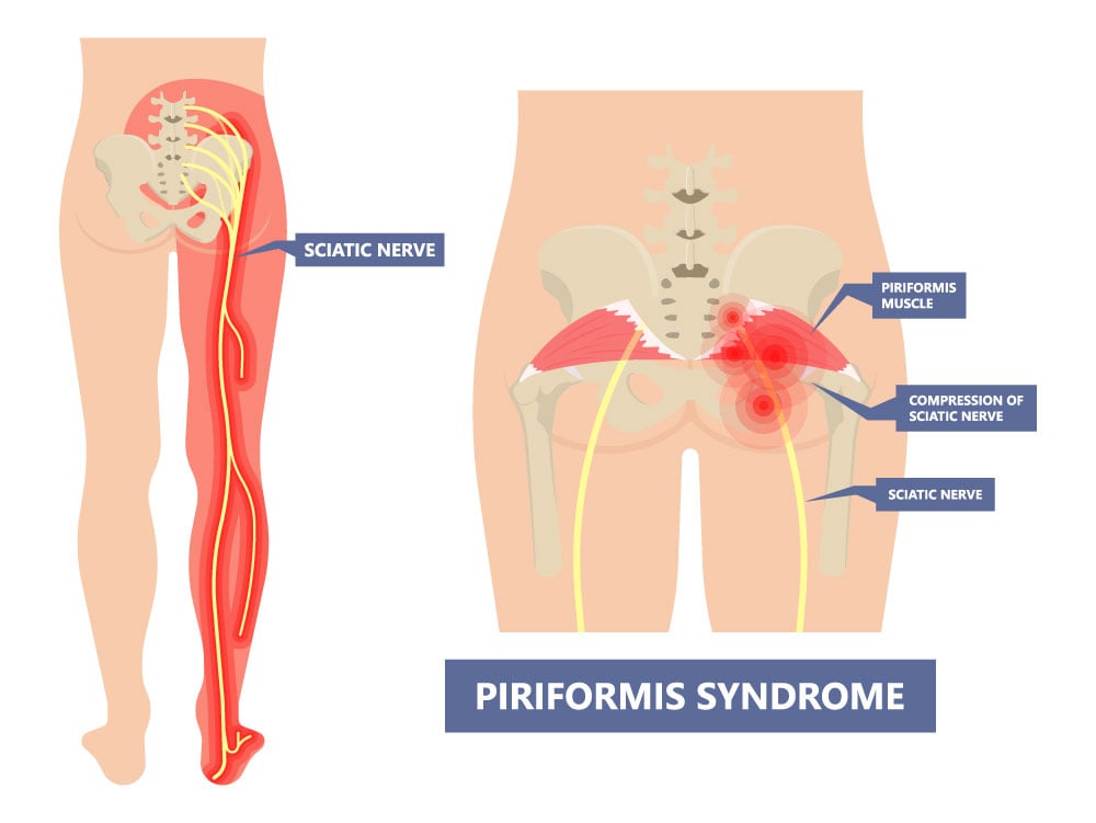 What Does Piriformis Syndrome Feel Like?