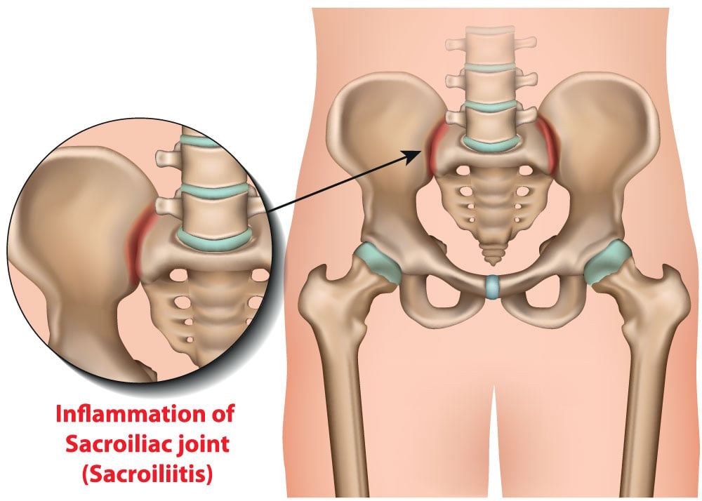 sacroiliac-joint-injection