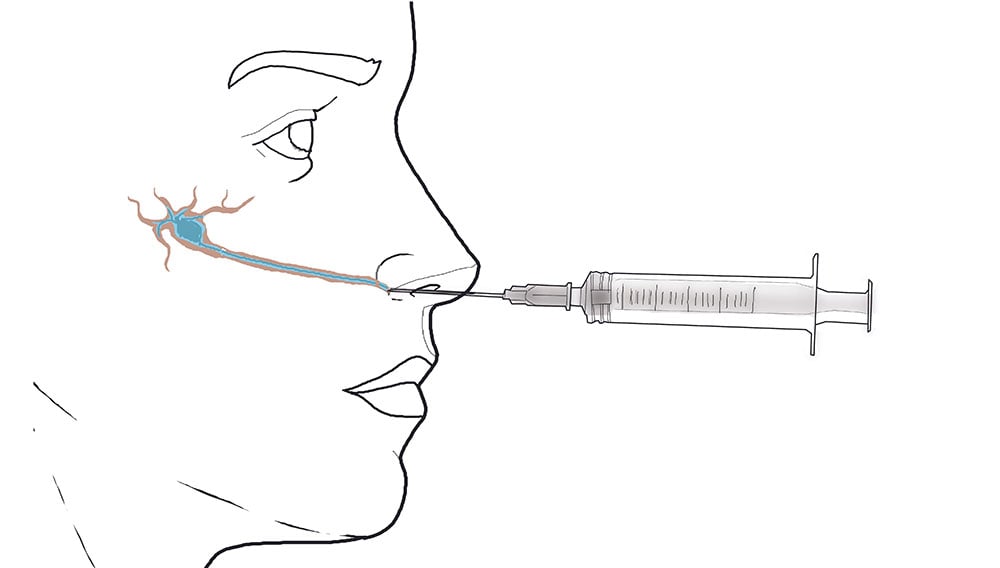 sphenopalatine-ganglion-nerve-block