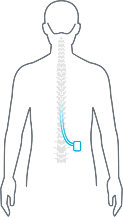 What is the Process for Spinal Cord Stimulators?