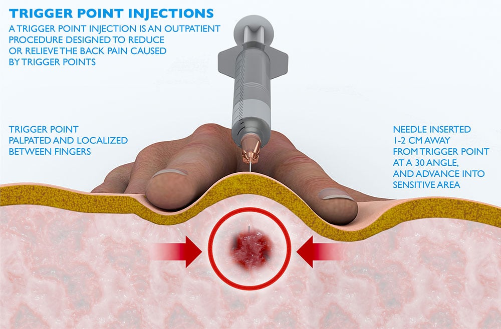 trigger-point-injections